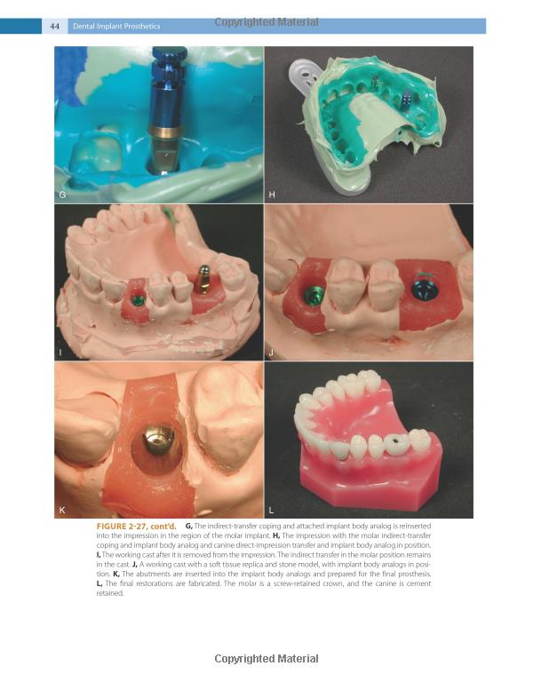 Dental Implant Prosthetics